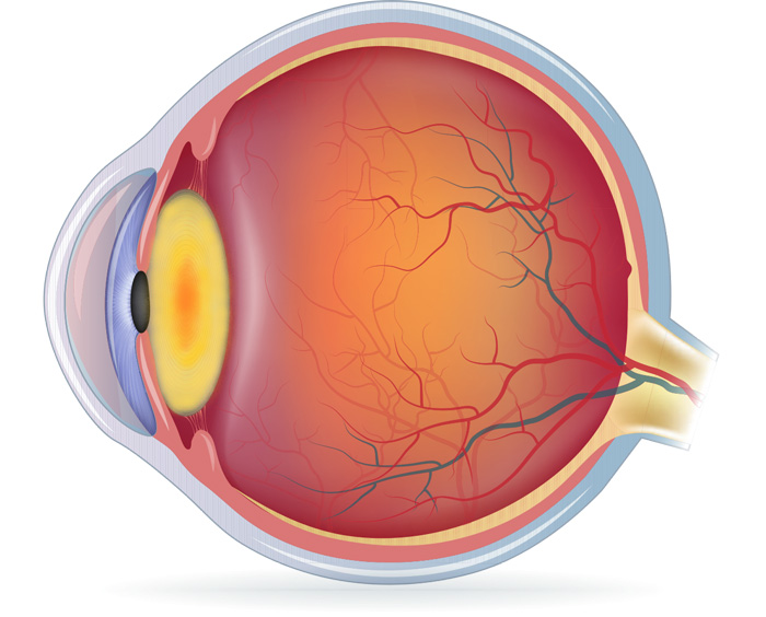 Schéma cataracte
