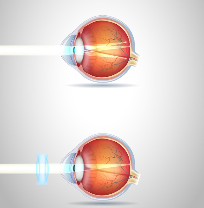 Qu’est-ce que l’astigmatisme ?