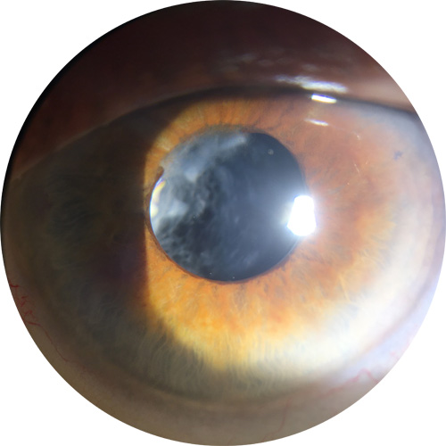 Cataracte secondaire Capsulotomie
