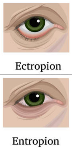 Ectropion - Entropion