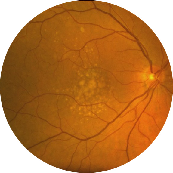 Fond d’oeil retrouvant des signes de maculopathie liée à l’âge (stade précurseur de la DMLA)