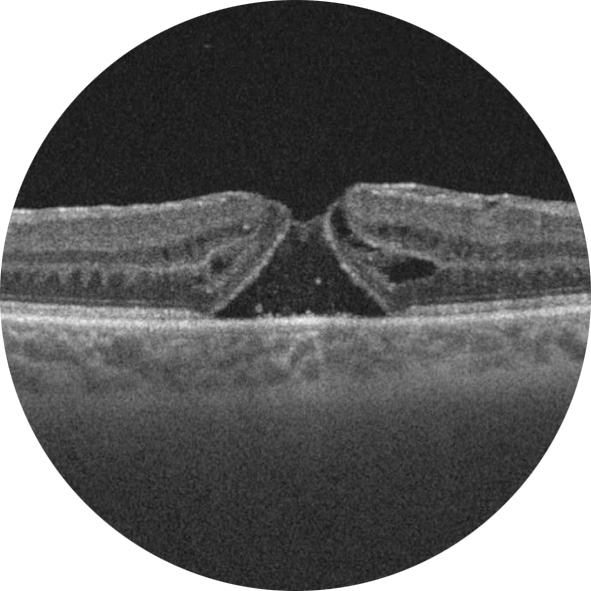 Tomographie à cohérence optique mettant en évidence un troumaculaire