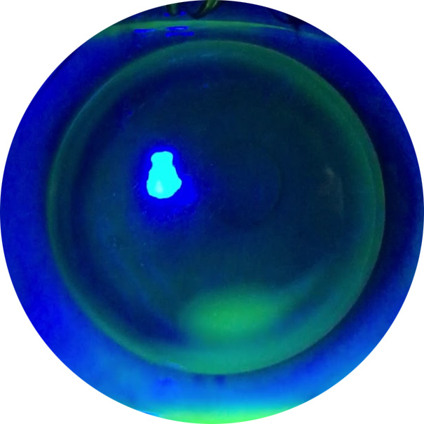 photographie en fluorescence d’une lentille rigide positionnée sur la cornée