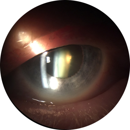 Pathologies cataracte